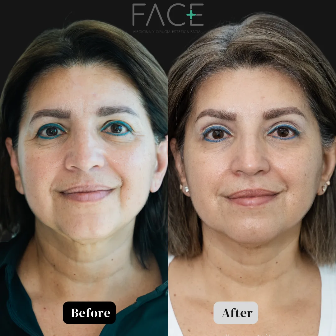 face lift Guatemala