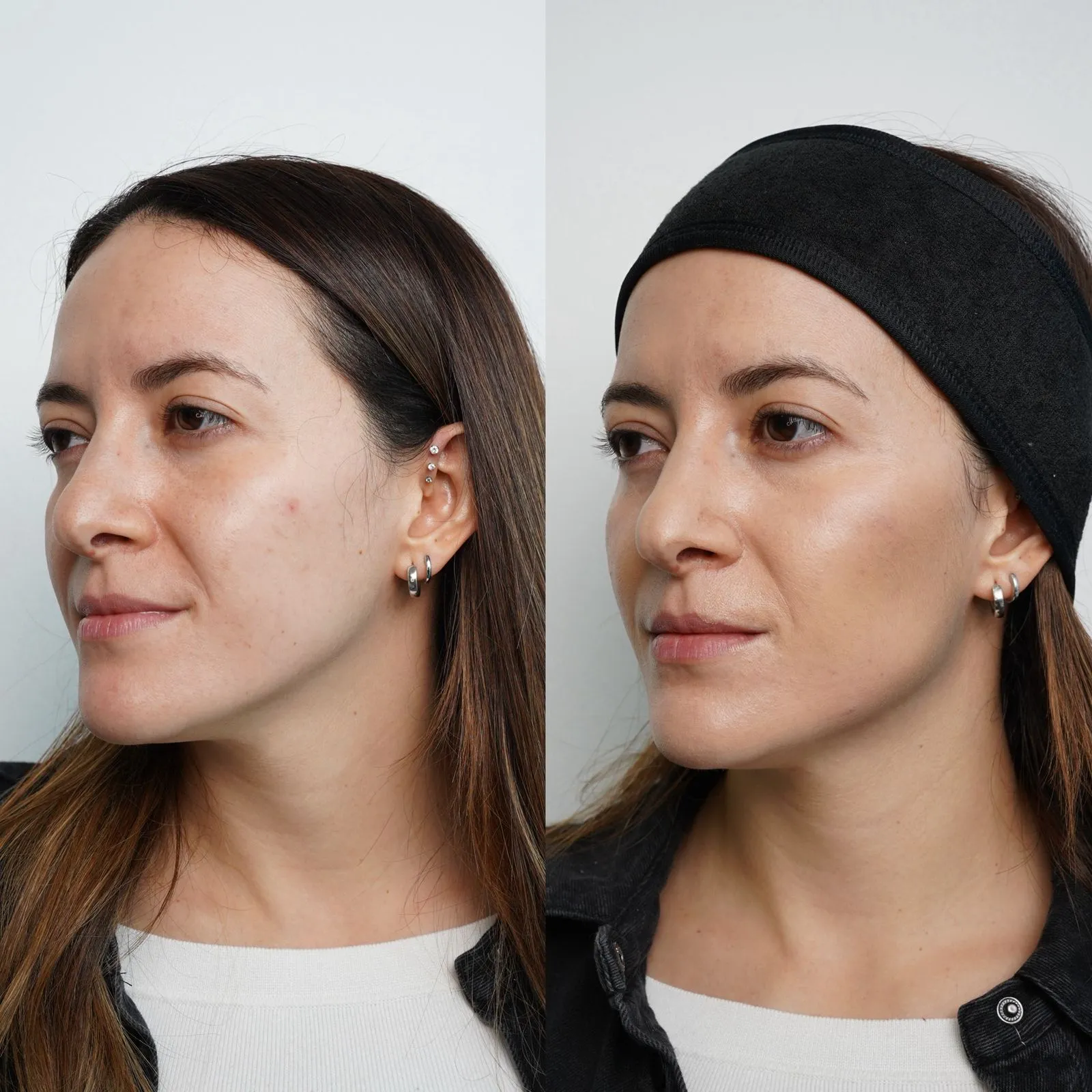 bioestimulador de colageno