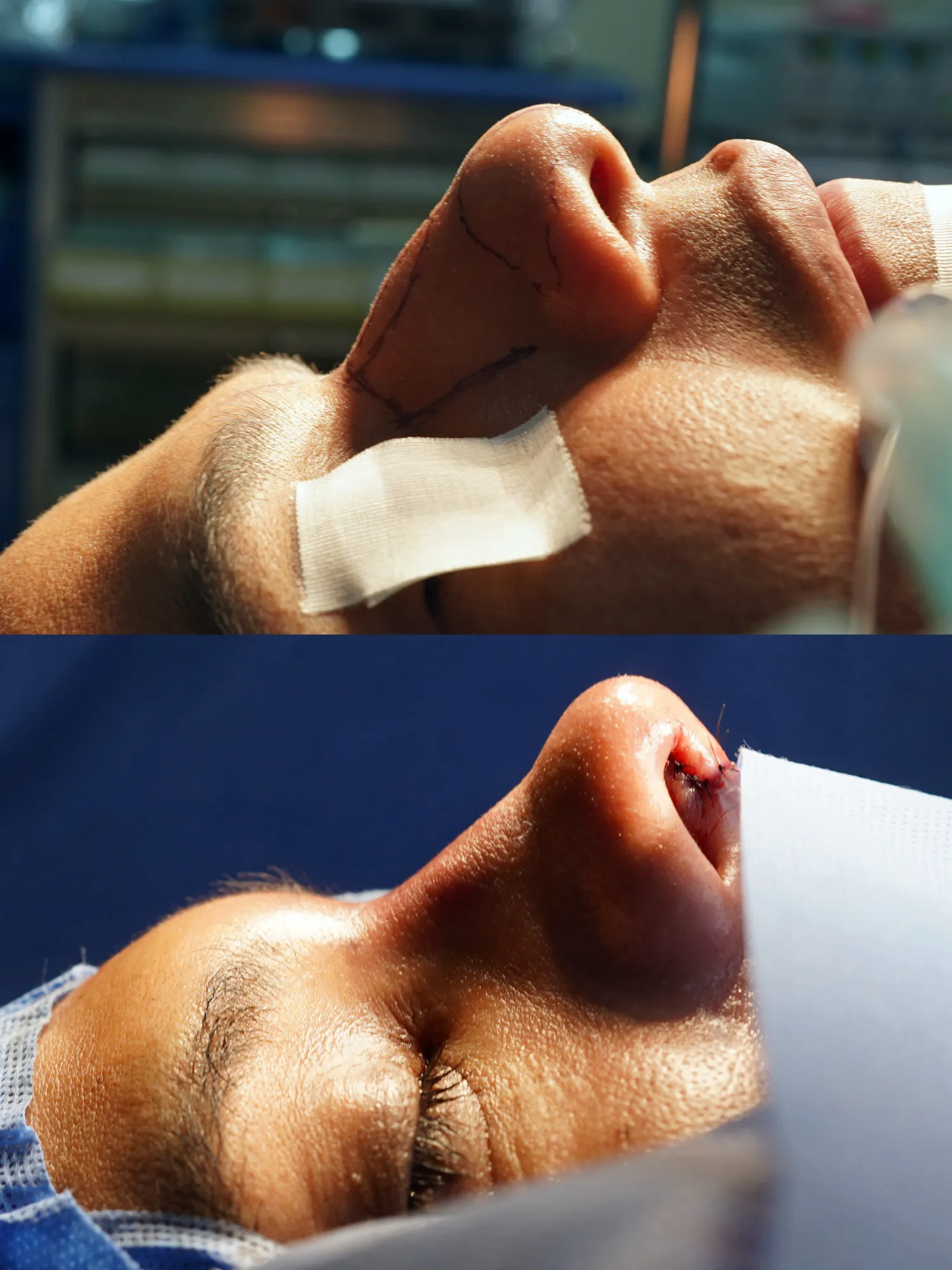 rinoplastia Guatemala