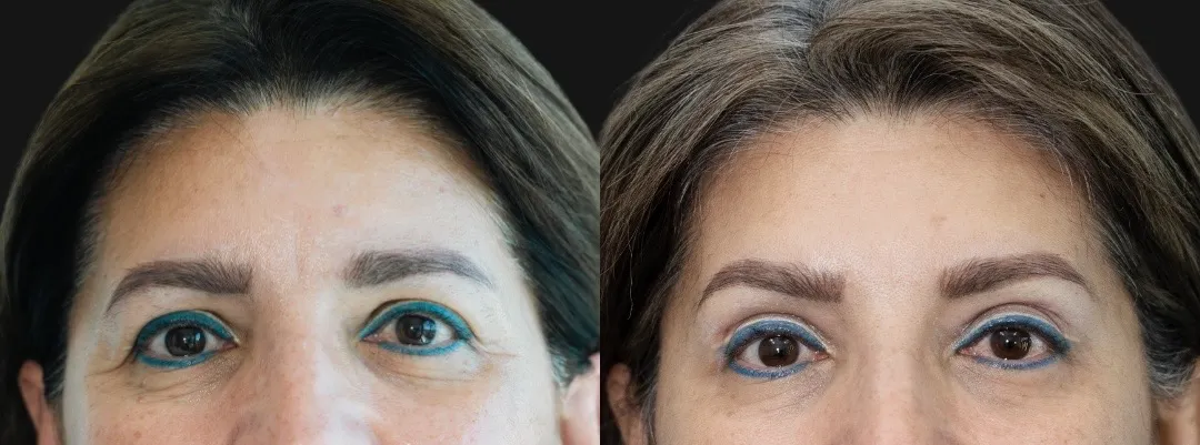 Blefaroplastia Guatemala