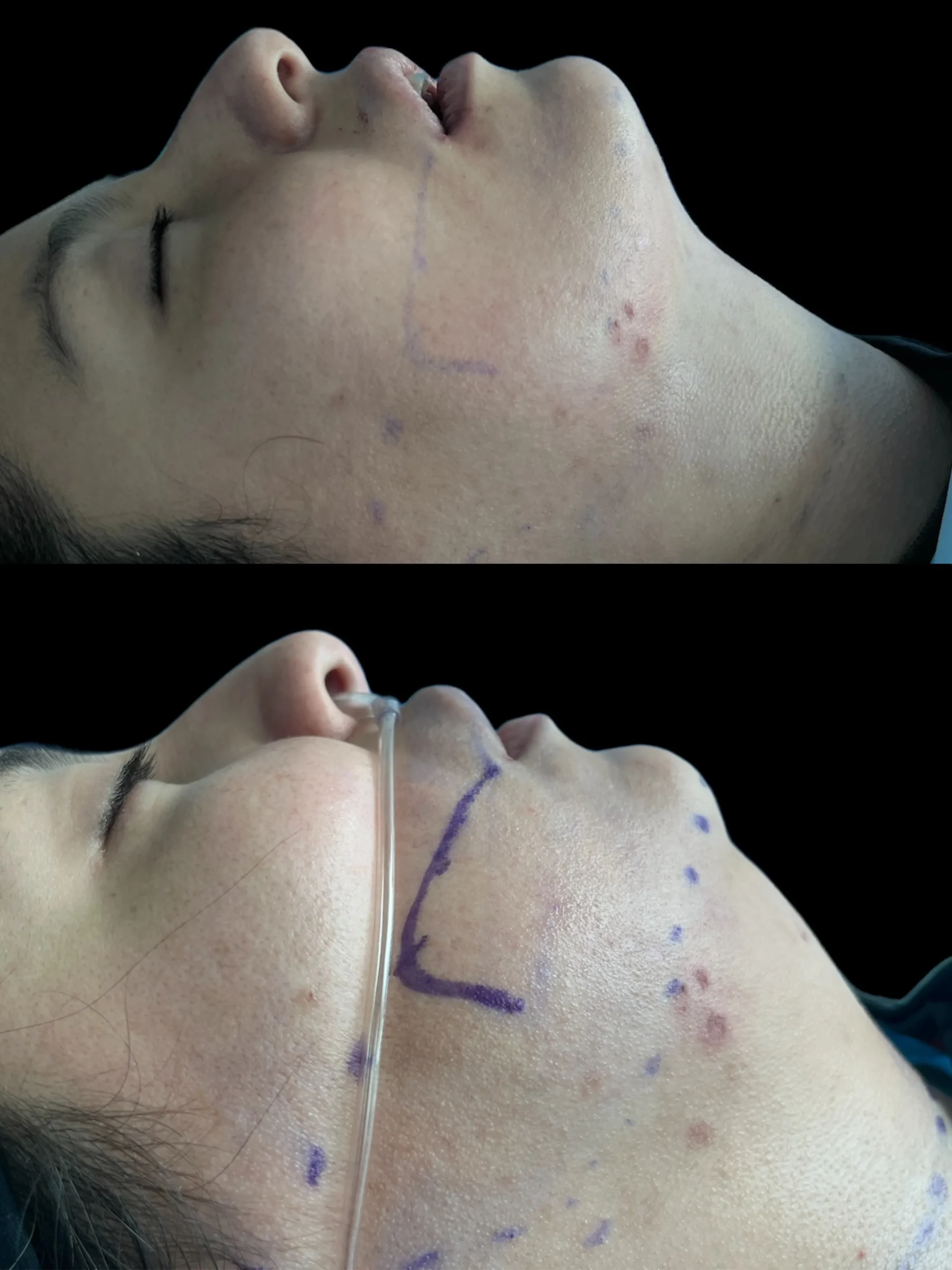 lipopapada Guatemala