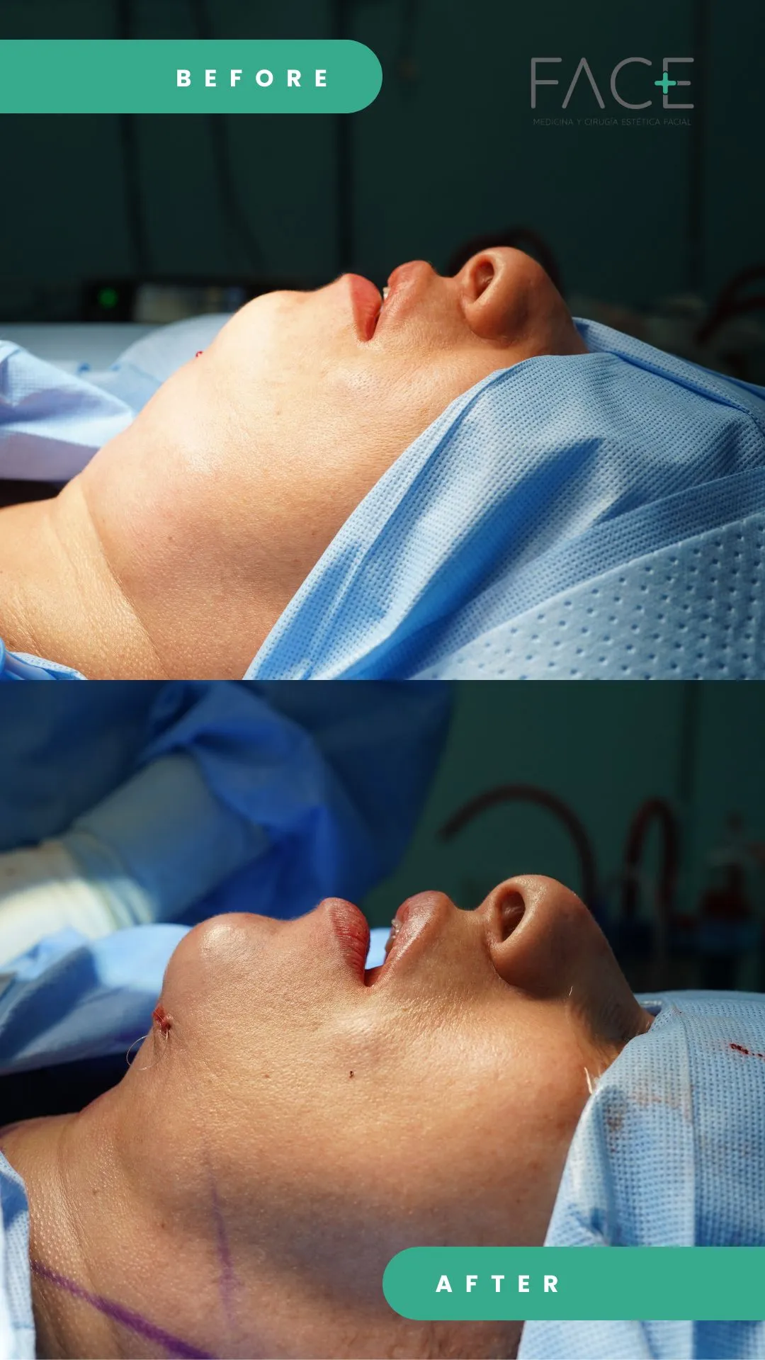 mentoplastia Guatemala